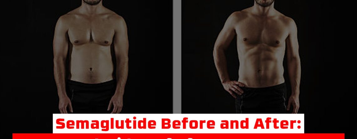 Semaglutide Before and After: Is Semaglutide Safe for Long-Term Use